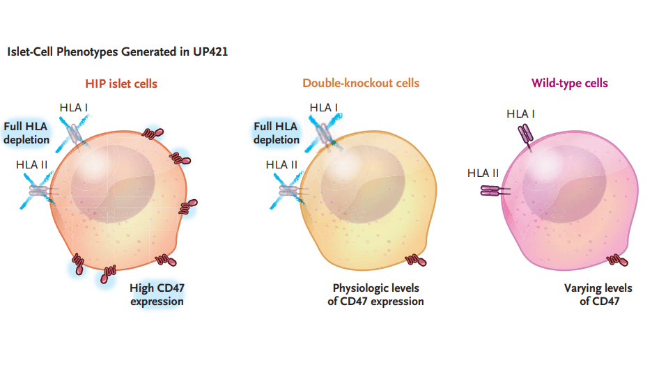 CRISPR Gene-Edited Islet Cells Survive 12 Weeks Without Immunosuppression in Type 1 Diabetes Patient